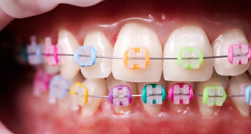 Learning The Basics About Rubber Bands On Braces Alan Carlotto